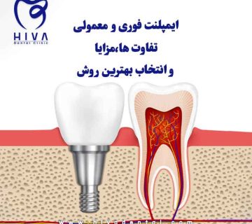 تصویر گرافیکی مقایسه ایمپلنت فوری و ایمپلنت معمولی در دندانپزشکی با نمای نزدیک دندان