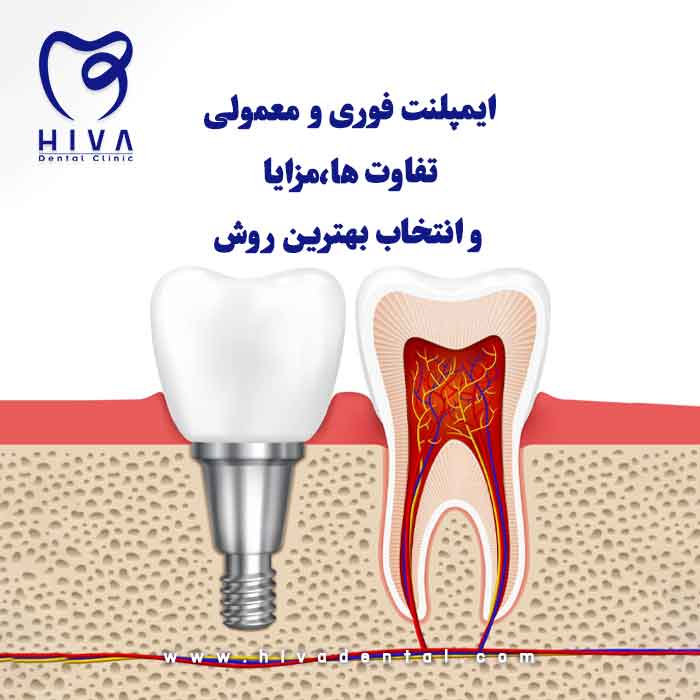 تصویر گرافیکی مقایسه ایمپلنت فوری و ایمپلنت معمولی در دندانپزشکی با نمای نزدیک دندان