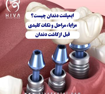 تصویر گرافیکی نمای نزدیک از قرار دادن قطعه فلزی ایمپلنت به جای دندان طبیعی