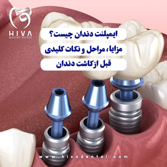 تصویر گرافیکی نمای نزدیک از قرار دادن قطعه فلزی ایمپلنت به جای دندان طبیعی
