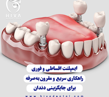 تصویر گرافیکی از قرارگیری قطعات فلزی ایمپلنت به جای دندان از نمای دورتر