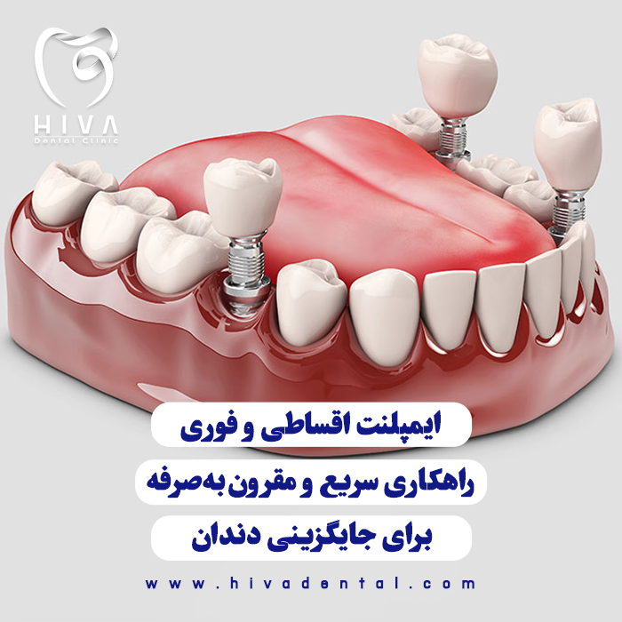 تصویر گرافیکی از قرارگیری قطعات فلزی ایمپلنت به جای دندان از نمای دورتر