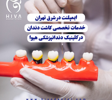 دستهای دکتر با دستکش در حال قرار دادن دندانهای مصنوعی روی قالب دندان (Dental Cast) برای کاشت ایمپلنت