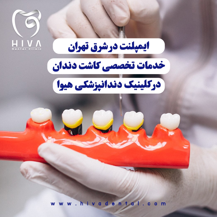 دستهای دکتر با دستکش در حال قرار دادن دندانهای مصنوعی روی قالب دندان (Dental Cast) برای کاشت ایمپلنت