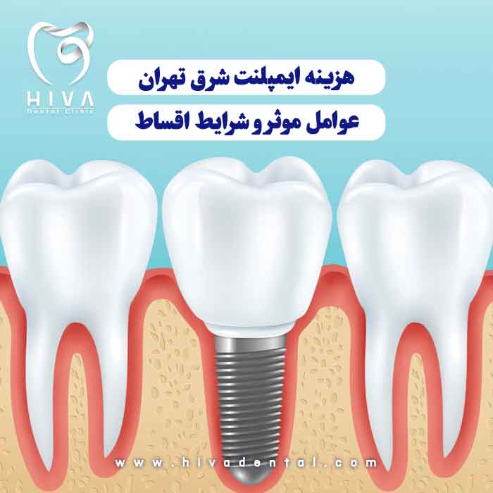 نمای نزدیک گرافیکی از دندان برای نمایش عوامل مؤثر در هزینه ایمپلنت و شرایط اقساط در شرق تهران