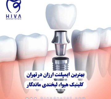 ایمپلنت دندان در کلینیک هیوا با قیمت مناسب و کیفیت بالا در تهران