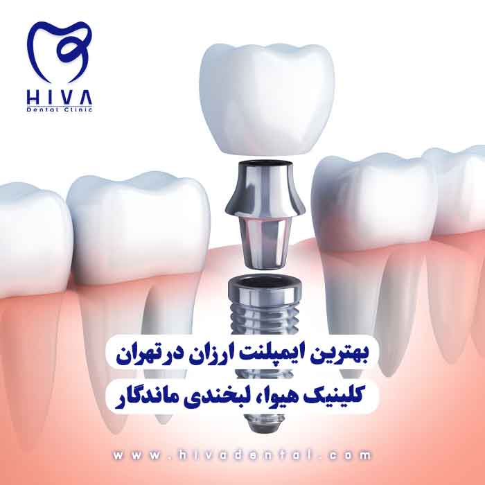 ایمپلنت دندان در کلینیک هیوا با قیمت مناسب و کیفیت بالا در تهران