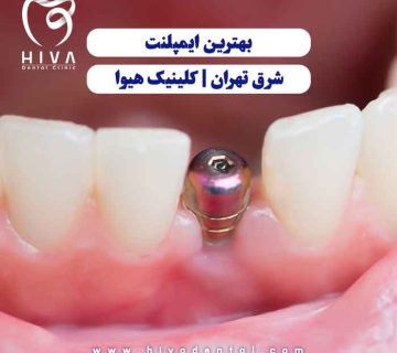 ایمپلنت دندان در حال نصب بین دو دندان طبیعی، نمادی از خدمات تخصصی و باکیفیت ایمپلنت در کلینیک هیوا شرق تهران
