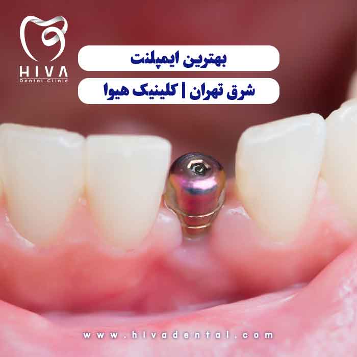 ایمپلنت دندان در حال نصب بین دو دندان طبیعی، نمادی از خدمات تخصصی و باکیفیت ایمپلنت در کلینیک هیوا شرق تهران