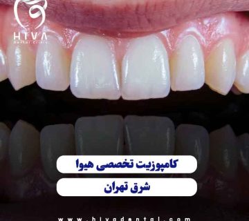 نمای نزدیک از اصلاح طرح لبخند با بهترین کامپوزیت شرق تهران در کلینیک دندانپزشکی هیوا