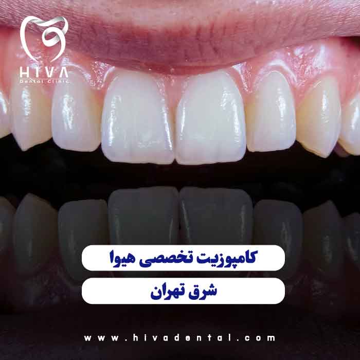 نمای نزدیک از اصلاح طرح لبخند با بهترین کامپوزیت شرق تهران در کلینیک دندانپزشکی هیوا