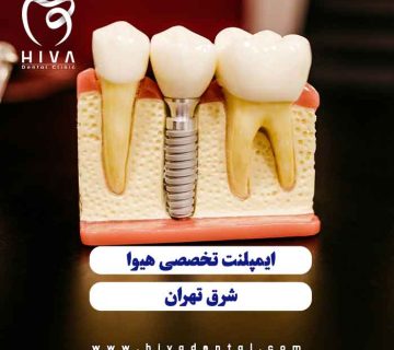 مدل آموزشی ساختار فیکسچر و روکش در بهترین ایمپلنت شرق تهران کلینیک هیوا