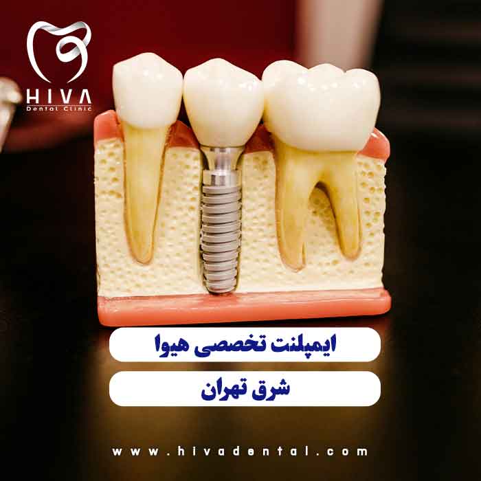 مدل آموزشی ساختار فیکسچر و روکش در بهترین ایمپلنت شرق تهران کلینیک هیوا
