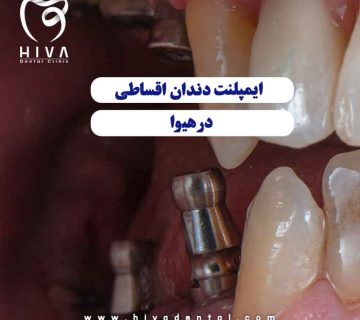 نمای داخلی از کاشت پایه فلزی ایمپلنت اقساطی شرق تهران در کلینیک دندانپزشکی هیوا