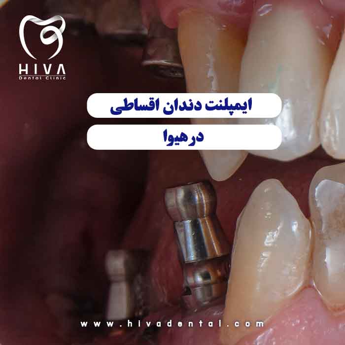 نمای داخلی از کاشت پایه فلزی ایمپلنت اقساطی شرق تهران در کلینیک دندانپزشکی هیوا