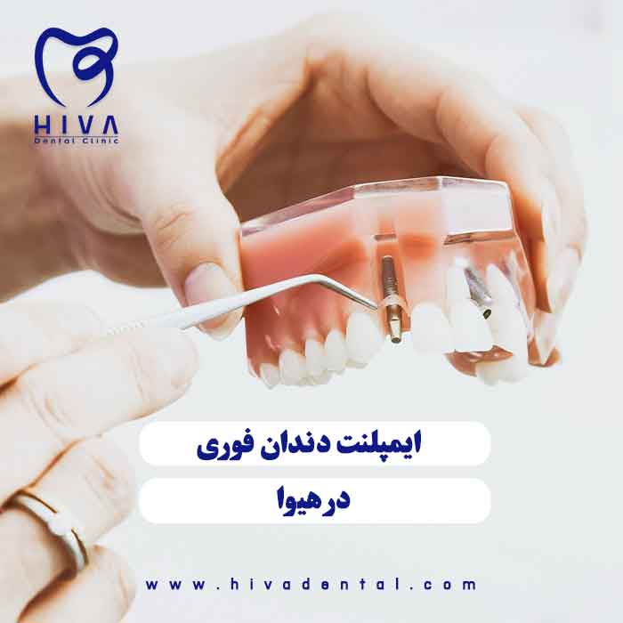 نمایش مدل جراحی و پایه گذاری ایمپلنت فوری شرق تهران در کلینیک هیوا
